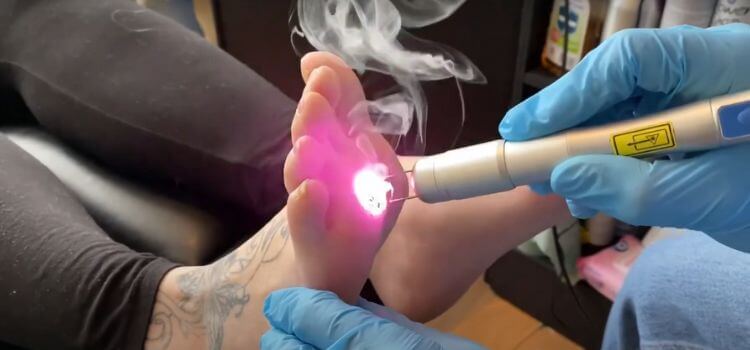 Laser Therapy for Foot Callus