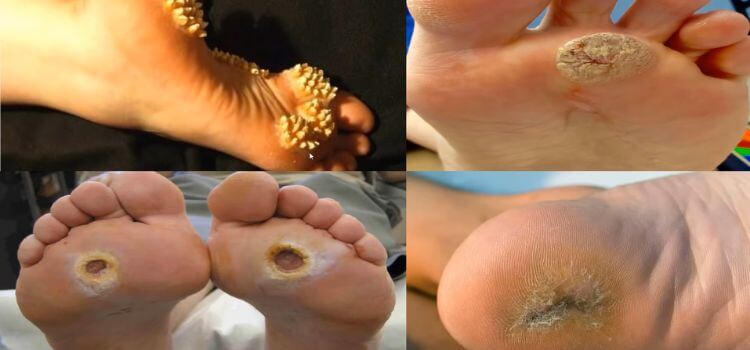 how to get rid of a foot callus