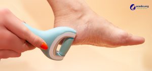 How to Use an Electric Callus Remover